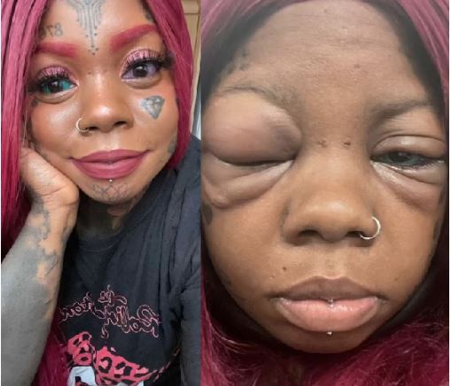 Mother Going Blind After Tattooing Her Eyeballs Blue And Purple To Copy An Influencer